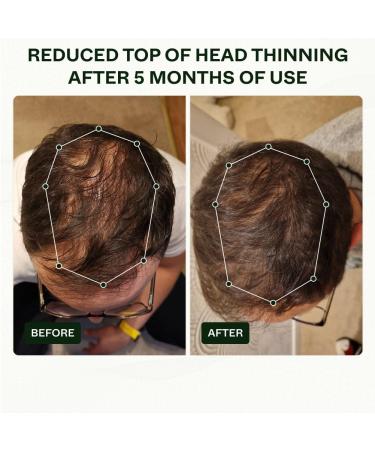 Scandinavian Biolabs Hair Growth System for Men | Clinically Proven Hair Loss Treatment in 45 Days - Buy Online on SooperMarket.com