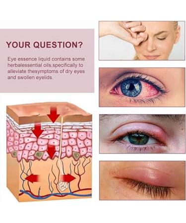 Eye Stye Remover for Fast Relief - Gentle Treatment for Styes  Chalazion  and Blepharitis - Buy Online on SooperMarket.com