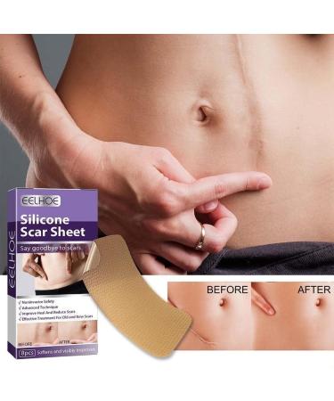 WAITLOVER Skin Color Reusable Silicone Scar Removal Patch - Surgical Self-Adhesive Soft Gel Strip for Burn Repair - Buy Online on SooperMarket.com