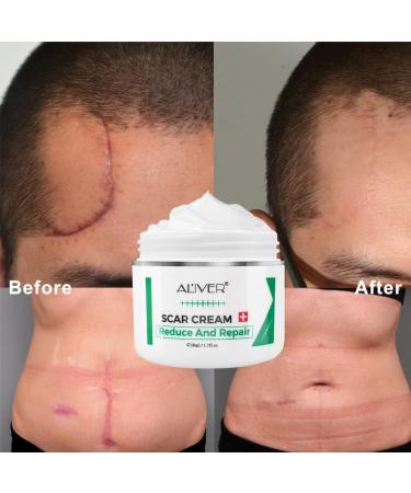 Scar Repair Cream | Acne Scar Removal & Pigmentation Corrector | Stretch Mark Remover | Skin Whitening | Scar Care - Buy Online on SooperMarket.com