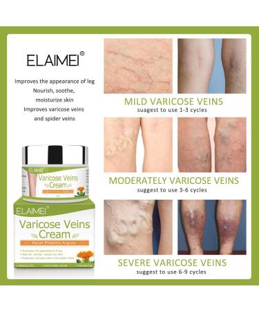 Varicose Veins Cream - Treatment for Phlebitis, Angiitis, Vasculitis, Spider Veins - Improve Blood Circulation for Tired, Heavy Legs - Fast Relief - Buy Online on SooperMarket.com