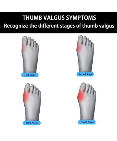 Orthopedic Toe Bunion Corrector Set Adjustable Day/Night Support for Pain Relief and Toe Alignment - Buy Online on SooperMarket.com