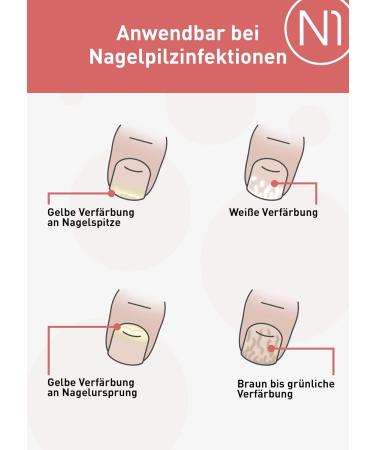 N1 Anti-Nail Fungus Solution 30ml | Medical Nail Polish Treatment for Quick Relief | Intensive Nail Care for Hands & Feet - Buy Online on SooperMarket.com