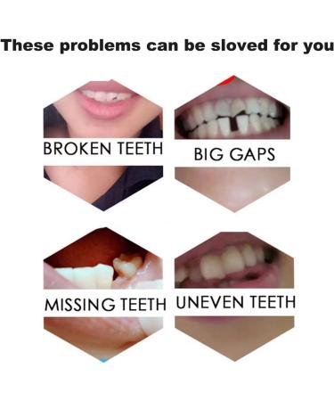 Fake Tooth Repair Kits for Filling The Missing Broken Tooth and Gaps-Moldable Fake Teeth and Thermal Beads Replacement Kits - Buy Online on SooperMarket.com