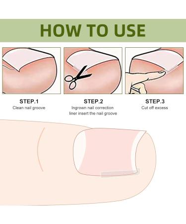 (12 +3) Ingrown Toenail Correction Treatment Kit Toenail Straightener Strips Recover Clips Plastics Ingrown Toenail Correction Strips Brace Kit for Women Men Ingrown Thick Nail - Buy Online on SooperMarket.com