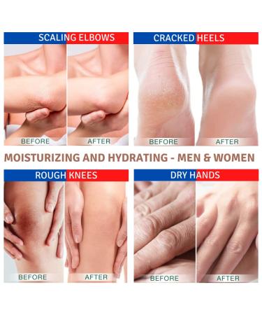 TIS 15% Urea Cream for Eczema Keratosis & Dry Skin | Healing with Lactic Acid & Wheat Germ Soap | 25g - Buy Online on SooperMarket.com