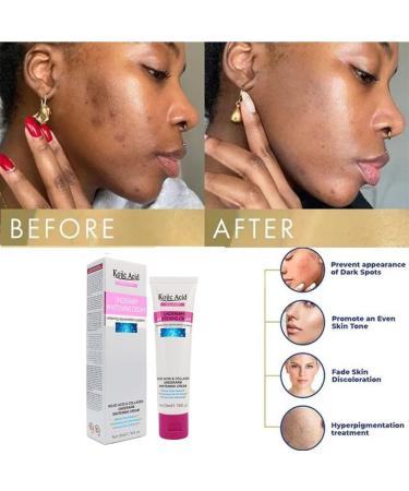 Kojic Acid Skin Lightening Cream Underarm Cream Intimate Area Dark Spot Corrector Whitening Cream for Body Underarms Armpit Knees Legs and Inner Thigh Cream for Acanthosis Nigricans Non-Greasy - Buy Online on SooperMarket.com