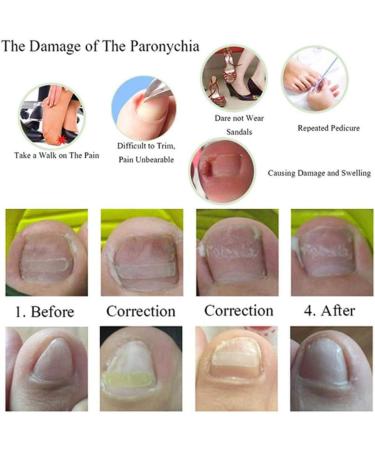 Toenail Tool 6 in 1 Ingrown Toe Nail Fixer Pedicure Toenail Recover Nail Foot Care Kit Ingrown Toenail Corrector for Men Women(24pcs) - Buy Online on SooperMarket.com