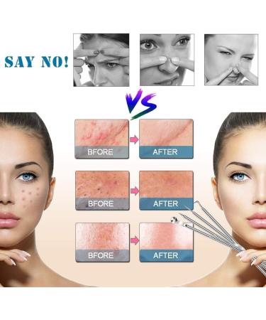 4PCS Blackhead Remover Tool Set for Acne, Comedone, Pimples, Spot, and Zit Extraction - Buy Online on SooperMarket.com