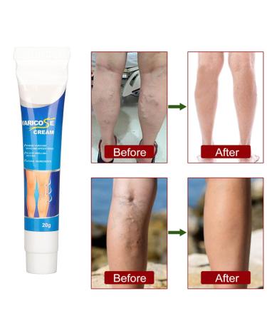 Varicose Veins Cream | Eliminate Spider Veins & Soothing Treatment - International Shipping - Buy Online on SooperMarket.com