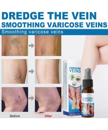 3 Pieces VeinHealing Varicose Vein Spray - Remove Varicose & Spider Veins Soothing Treatment for Legs 30ml | Improve Blood Circulation - Buy Online on SooperMarket.com