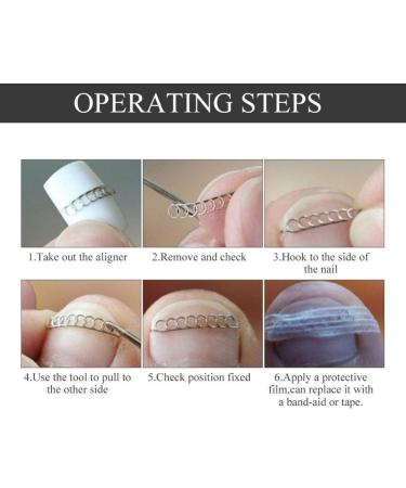 Nail Corrector Pedicure Tool - 12Pcs/Box Toenail Correction Kit for Ingrown Nails - Foot Care Fixer in 6 Sizes - Buy Online on SooperMarket.com