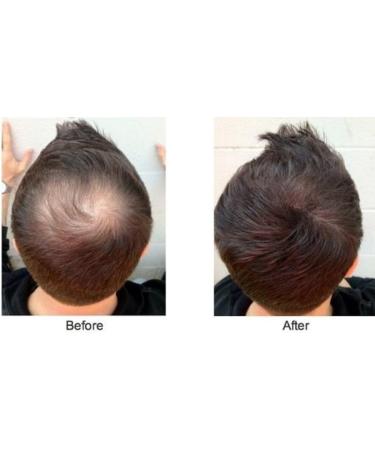 Caboki Hair Loss Concealer Hair Building Fiber 25g (Black) - Buy Online on SooperMarket.com