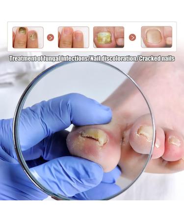 Nail Fungus Removal Liquid - Natural Toenail Fungus Oil for Effective Nail Care | BTSEURY - Buy Online on SooperMarket.com