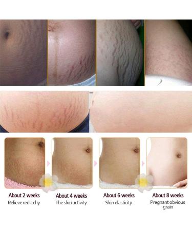RtopR Mango Stretch Marks & Scar Cream - Pregnancy Safe Moisturizer - 80g (Pack of 2) - Buy Online on SooperMarket.com