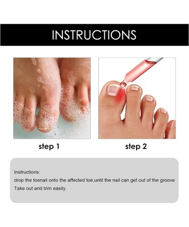Ingrown Toenail Treatment - 30ml Ingrown Toenail - Cuticle Care Oils for Ingrown Toenails - Trimming Toenail Softening Drops Natural Ingrown Toenail Correction Treatment Fungal Nail Treatment - Buy Online on SooperMarket.com