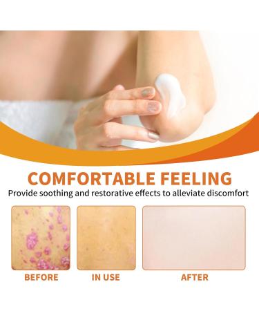 Bee Venom Psoriasis Cream Bee Venom Cream for Psoriasis New Zealand Bee Venom Body Care Chinese Herbal Cream Soothing Psoriasis Cream Body Cream for Redness & Itching & Soothing (1) - Buy Online on SooperMarket.com