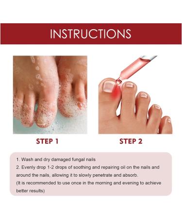 Toenailplus Anti Paronychia Relief Oil - 10ml 2pcs - Nail Helper for Ingrowth Toenail Correction & Paronychia Treatment - Buy Online on SooperMarket.com
