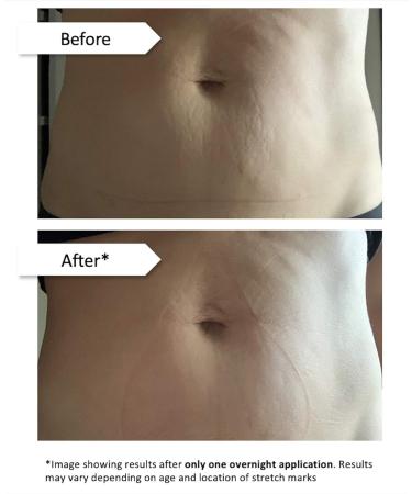 Stretch Mark Eraser | Overnight Treatment for Stretch Marks | 1 Patch | Fast Shipping Worldwide - Buy Online on SooperMarket.com