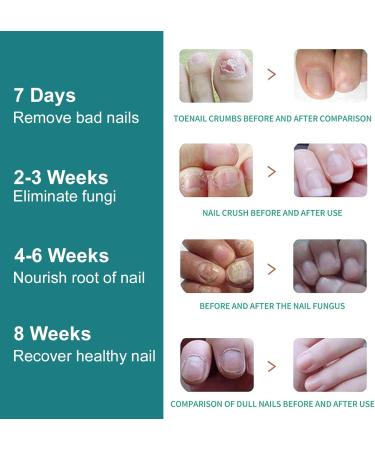 Blue Light Nail Fungus Laser Treatment Device with Timer for Home Use - Touch Screen Nail Repair - Buy Online on SooperMarket.com