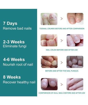 Touchscreen Nail Fungus Laser Treatment Device - Targets Damaged Toenails - Onychomycosis Treatment - Buy Online on SooperMarket.com