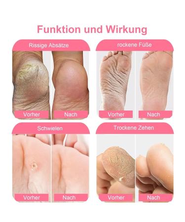 Buy SDSM Foot Mask for Hard Skin - 2 Pairs of Peeling Socks for Dead Skin & Cracked Heels - Plant-Based Moisturizing Formula for Baby Soft Feet (Rose) - International Shipping Available - Buy Online on SooperMarket.com