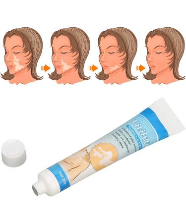 Vitiligo Cream 30G - Herbal Extract Treatment for White Spots & Skin Pigmentation - Creme Medix Leukoplakia Solution - 0.7oz - Buy Online on SooperMarket.com