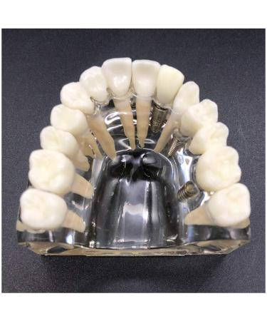 Implant Tooth Template | Oral Simulation Dental Study Model for Teaching - Shop Internationally - Buy Online on SooperMarket.com