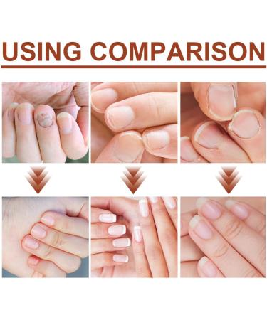 7 Days Nail Growth and Strengthening Serum Nail Serum for Strength and Growth Nail Repair Essence Serum - Buy Online on SooperMarket.com