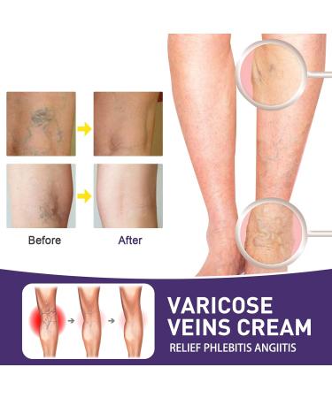 Varicose Vein & Spider Vein Cream | Capillary Health Treatment | Improve Circulation 0.7oz - Buy Online on SooperMarket.com