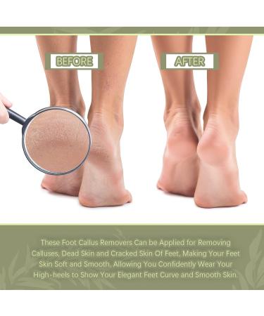 Double Sided Foot File Pedicure Foot Care Repair Tool Reusable Foot Scraper Hard Skin Remover Calluses Dead Skin Remover for Feet Foot Rasp File Foot Scrubber for Peel Wet Dry Cracked Feet Heel (Blue) - Buy Online on SooperMarket.com