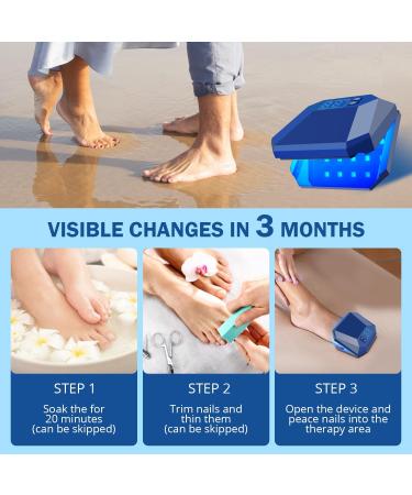 Nail Fungus Cleaning Device for Multiple fingers 905nm Infrared Light + 470nm Blue Light Highly Effective Treatment for Home Use Treat and effectively prevent (Navy) - Buy Online on SooperMarket.com