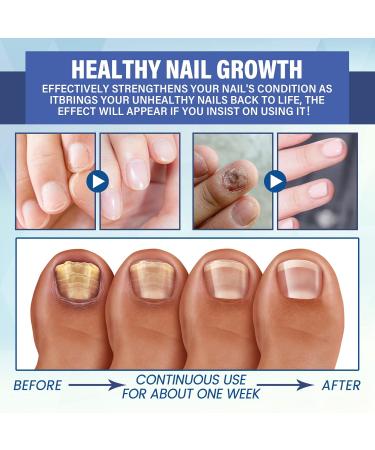 NailPro Nail Fungus LED Light Therapy Device Nail Fungus Laser Nail Fungus Treatment Home Use Nail-Fungus Remover for Toenail Fingernails & Onychomycosis (A01) - Buy Online on SooperMarket.com