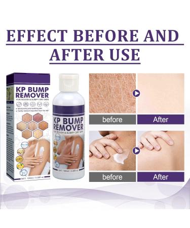 Bump Removal Cream - Skin Repair Peeling & Deep Moisturizing Beauty Base for All Skin Types - Buy Online on SooperMarket.com