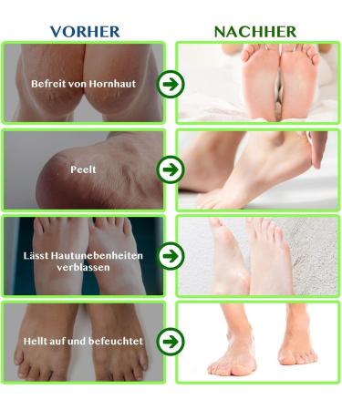 P-Beauty Footmaster Aloe - Intensive Foot Care Peeling Socks | Remove Rough Skin Cracks & Calluses | 5 Pairs for Silky Soft Feet - Buy Online on SooperMarket.com