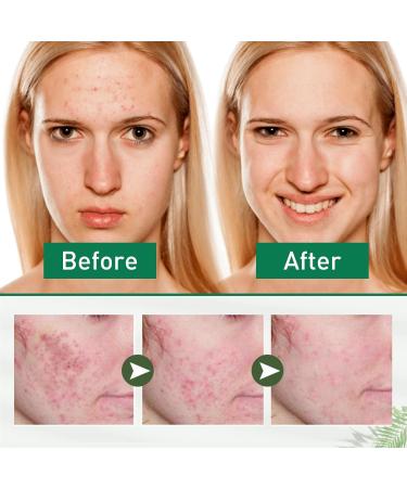 Tea Tree Ance Treatment Serum Tea Tree Oil For Skin Tea Tree Essential Oils Anti-Pimples and Acne Moisturizer and Brighten Skin.Tea Tree Oil for Diffuser Humidifier DIY Home Office 17ml - Buy Online on SooperMarket.com