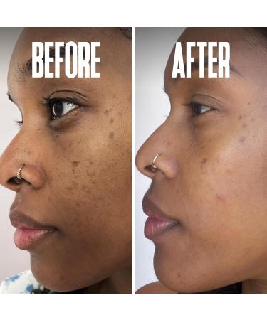 Dark Spot Corrector Serum - Remove Stubborn Dark Spots with Kojic Acid & Alpha Arbutin | Brightening Discoloration Remover for Face - Buy Online on SooperMarket.com