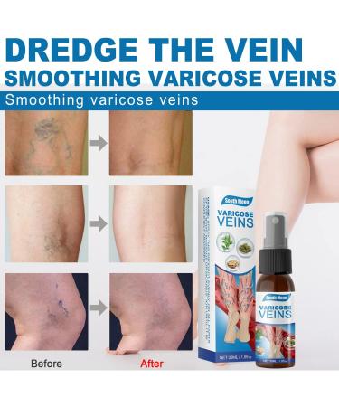 2pcs Veinhealing Varicose Veins Treatment Spray Veinhealing Varicose Veins Spray Vein Healing Varicose Veins Treatment Spray for Legs Varicose Veins Miracle Spray (30ml) - Buy Online on SooperMarket.com