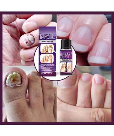 Fungal Nail Treatment 30ml Extra Strong Nail Fungus Treatment for Toenail and Fingernail Premium Fungal Nail Eliminator Anti fungus Nail Repair and Strengthen Fix & Renew Damaged Broken Nails - Buy Online on SooperMarket.com