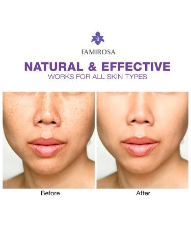 Dark Spot Remover Serum for Face & Body | Age Sun Spots, Freckles, Melasma Treatment | 4-Butylresorcinol, Kojic Acid, Hyaluronic Acid - 50ml - Buy Online on SooperMarket.com