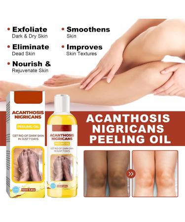 Extra Strong Peeling Oil - Chemical Exfoliant for Face & Body | Reduces Wrinkles Stretch Marks & Dead Skin - Buy Online on SooperMarket.com