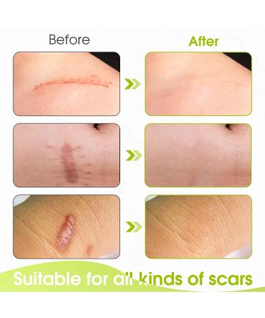 Soft Silicone Scar Tape Roll 1.6x 120 (8 Month Supply) | Reusable & Effective Scar Removal for C-Section, Keloid Surgery, Burn & Acne - Buy Online on SooperMarket.com