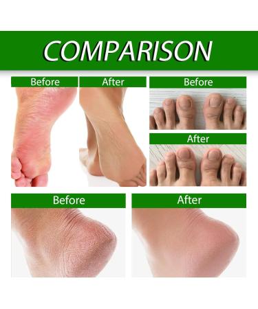 Urea Cream 40 Percent for Feet 40% Urea Cream for Cracked Heels and Dry Skin Aloe Vera Foot Cream with Tea Tree Oil Deep Moisturizing Callus Remover Nourishes Soften for Feet/Knees/Hands/Elbows - Buy Online on SooperMarket.com