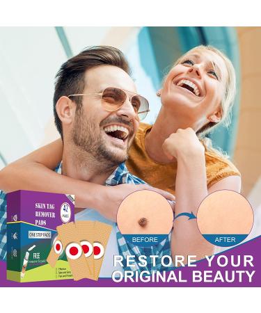 Skin Tag & Wart Remover Pads - Extra Strength, Fast & Safe Removal - 42 Count Pack - Suitable for All Skin Types - Buy Online on SooperMarket.com