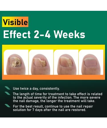 XIFEPFR Toenail Repair Treatment - Extra Strength Nail Renewal Solution for Thick, Brittle, and Discolored Nails - Buy Online on SooperMarket.com