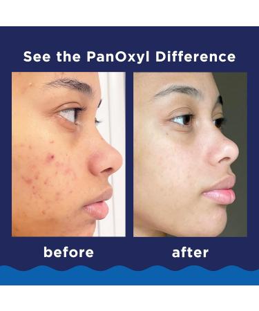 PanOxyl Acne Foaming Wash 10% Benzoyl Peroxide | Maximum Strength Treatment - 5.5 oz - Buy Online on SooperMarket.com