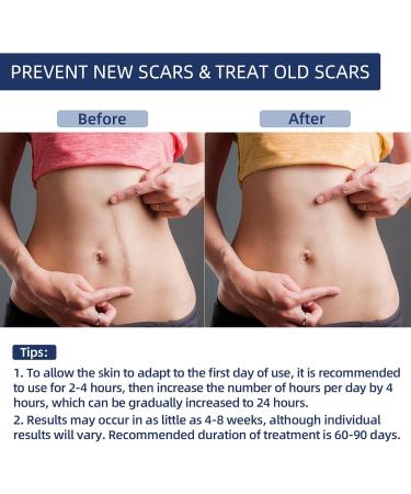 Silicone Scar Tape for Surgical Scars - Extra Long Scar Sheets for C-Section (59 in x 1.5 in) - Buy Online on SooperMarket.com