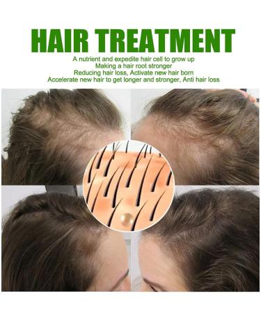 Neo Hair Lotion 120ml - Revitalize and Strengthen Your Hair - Buy Online on SooperMarket.com