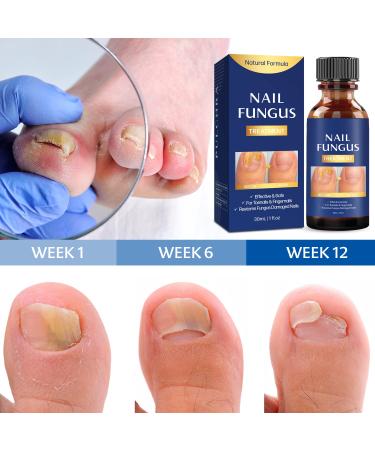 Extra Strength Toe Nail Fungus Treatment - Effective Nail Repair Solution for Healthy Nails - Buy Online on SooperMarket.com