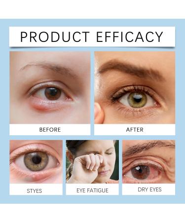 Stye Eye Treatment & Chalazion Remover | Eye Relief Serum & Gentle Lash Cleanser - Fast International Shipping - Buy Online on SooperMarket.com